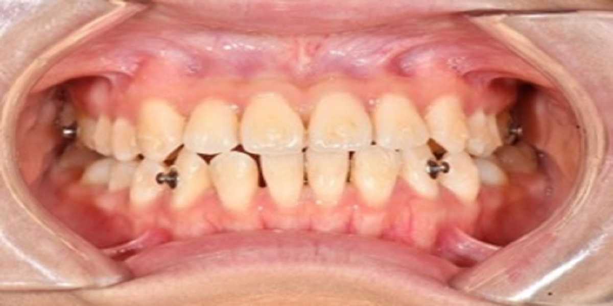 Crossbite after treatment