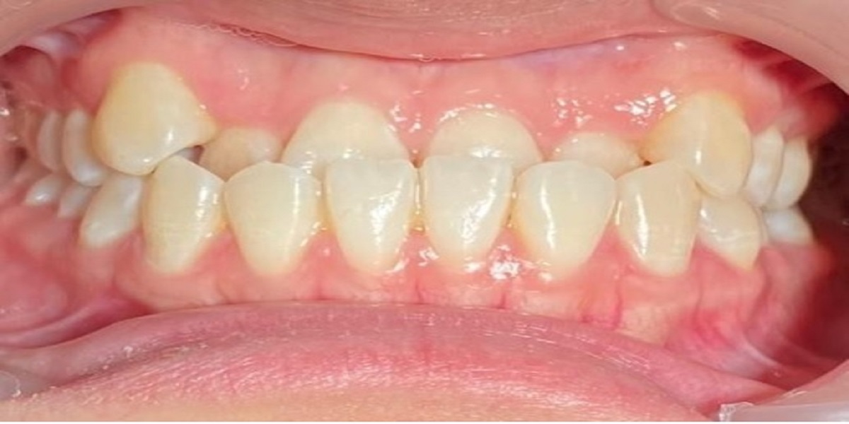 Crossbite before treatment