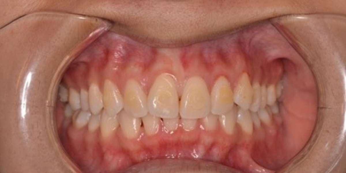 Crowding after treatment