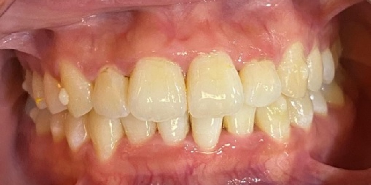 Crowding after treatment