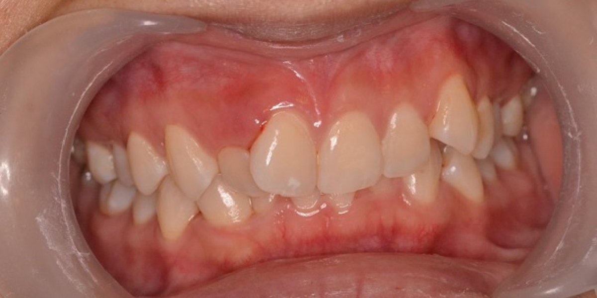 Crowding before treatment