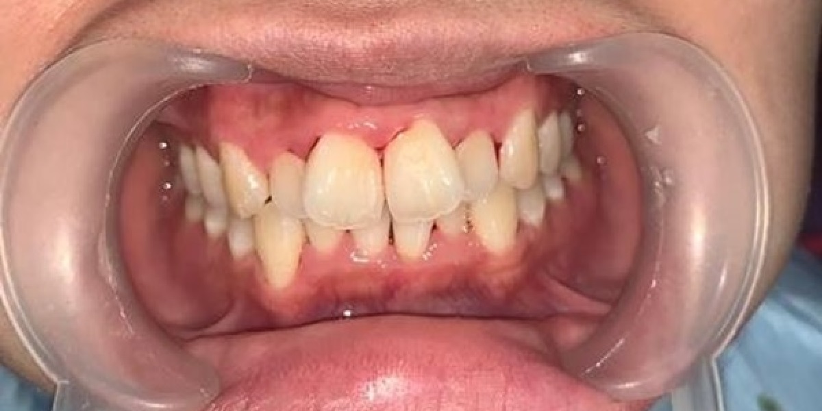 Crowding before treatment