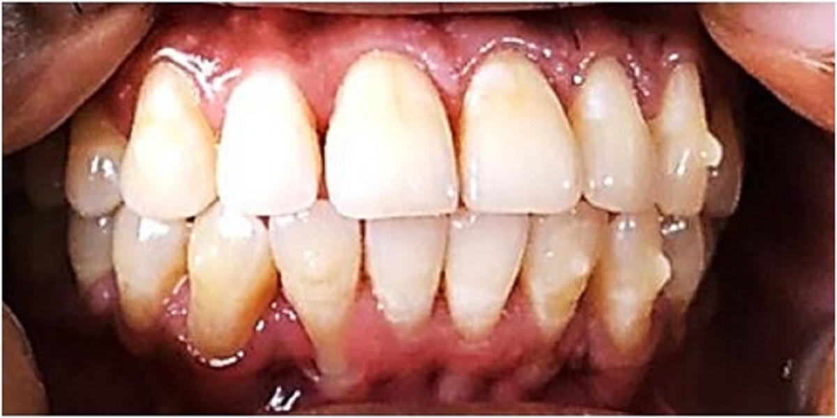 Openbite after treatment