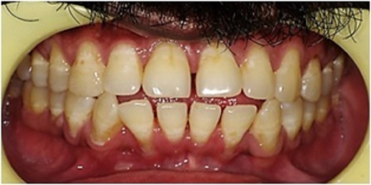 Openbite before treatment