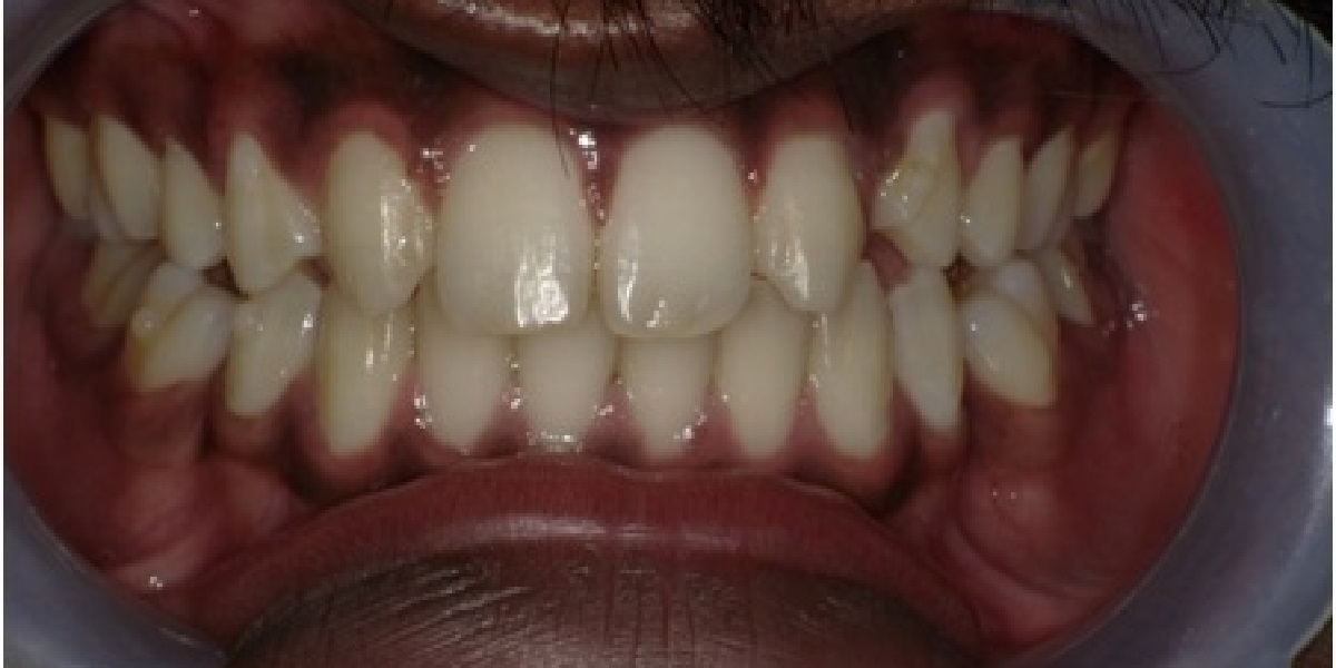 Spacing after treatment