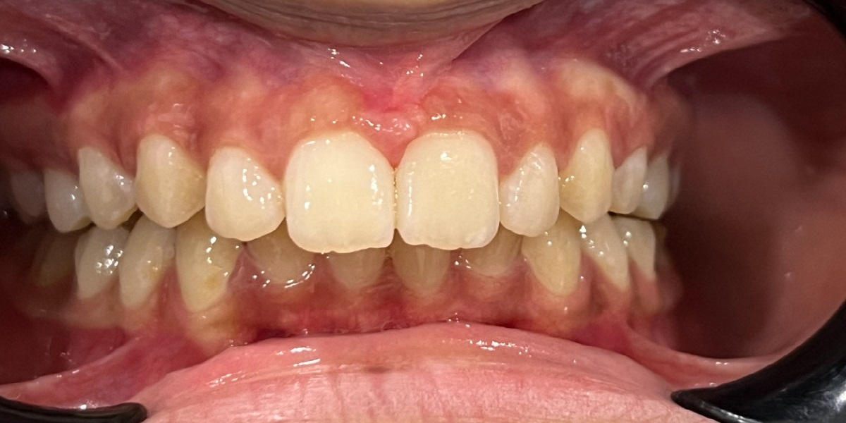 Spacing after treatment