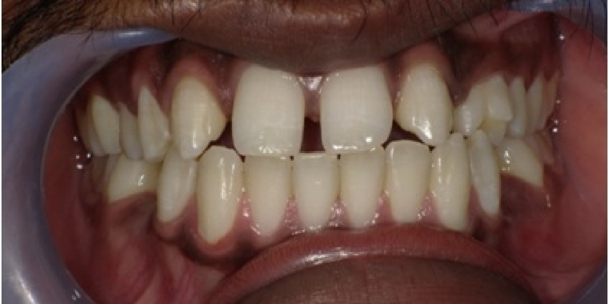 Spacing before treatment