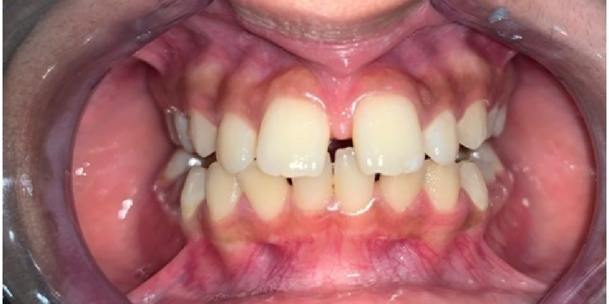 Spacing before treatment